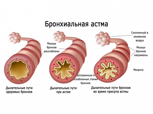 Лечение астмы с помощью ингалятора или небулайзера